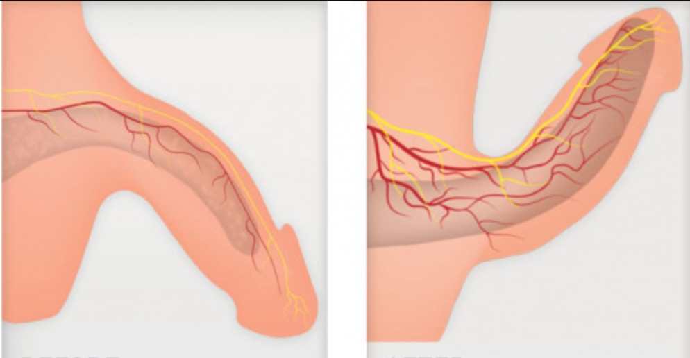 Diagrama mostrando as diferentes curvaturas do pênis